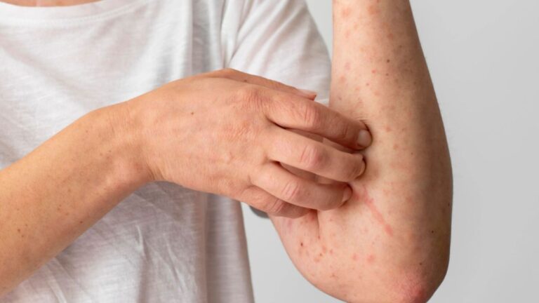 Atualização sobre os Casos de Mpox na Bahia: Cenário Atual e Detalhes Atualização sobre os Casos de Mpox na Bahia: Cenário Atual e Detalhes