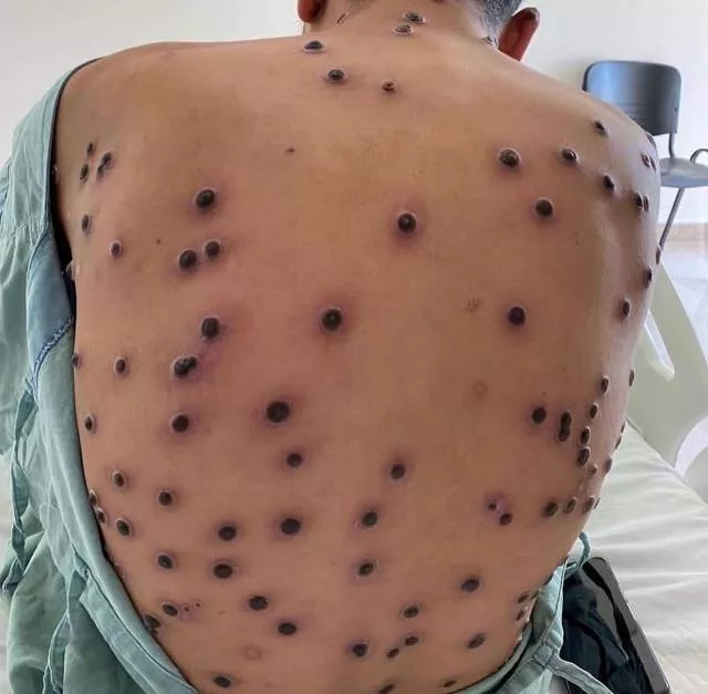 Bahia Monitora Casos Suspeitos de Mpox: Entenda a Situação Atual Bahia Monitora Casos Suspeitos de Mpox: Entenda a Situação Atual