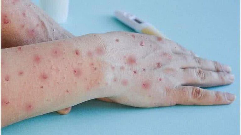 Bahia Registra Primeiros Casos de Mpox em 2024: Saiba Mais Sobre a Doença