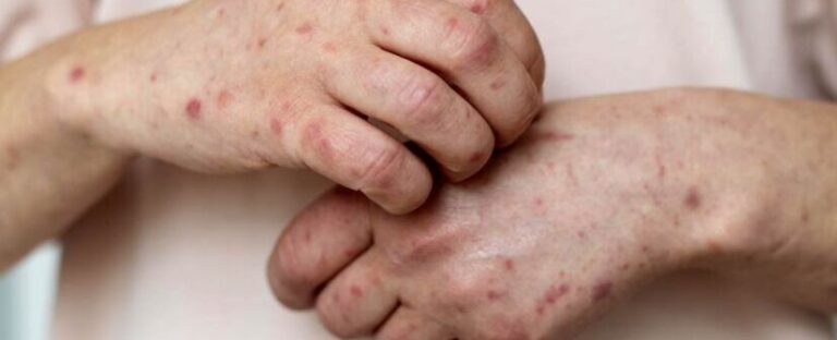 Caso de Mpox é Descartado em Vitória da Conquista: Bahia Registra Apenas um Caso Confirmado Caso de Mpox é Descartado em Vitória da Conquista: Bahia Registra Apenas um Caso Confirmado