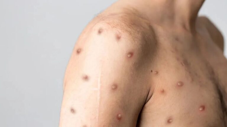 Mpox na Bahia: Dois Casos Confirmados e Outros em Investigação Mpox na Bahia: Dois Casos Confirmados e Outros em Investigação