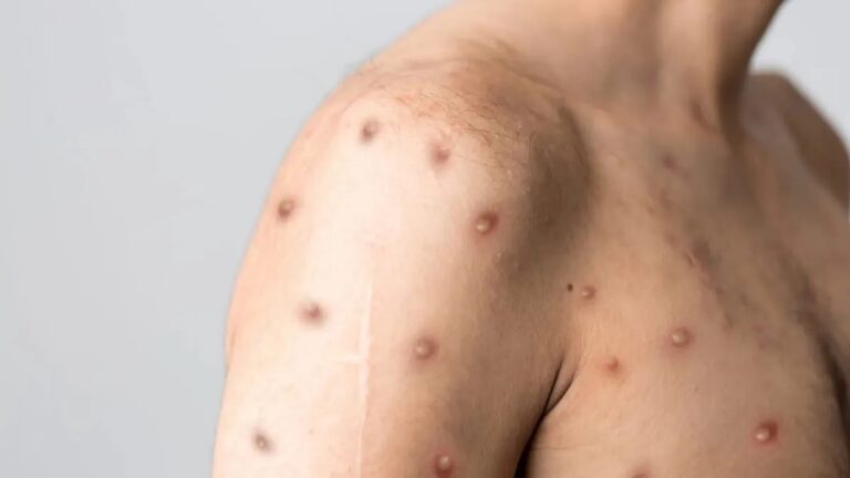 Secretaria da Saúde da Bahia Desmente Boatos Sobre Mpox: Apenas 7 Casos Suspeitos Secretaria da Saúde da Bahia Desmente Boatos Sobre Mpox: Apenas 7 Casos Suspeitos